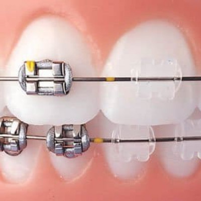 Брекети металеві чи керамічні, які вибрати